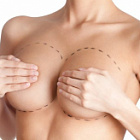 Увеличение груди (мастопексия)